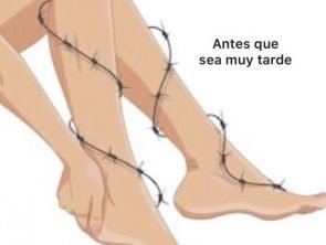 várices